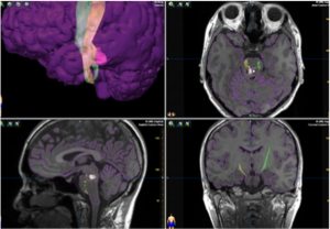 脳幹部海綿状血管腫症例におけるdiffusion tensor imagingです。手術治療前に手足を動かす運動神経と病変との位置関係を立体的に把握します。
